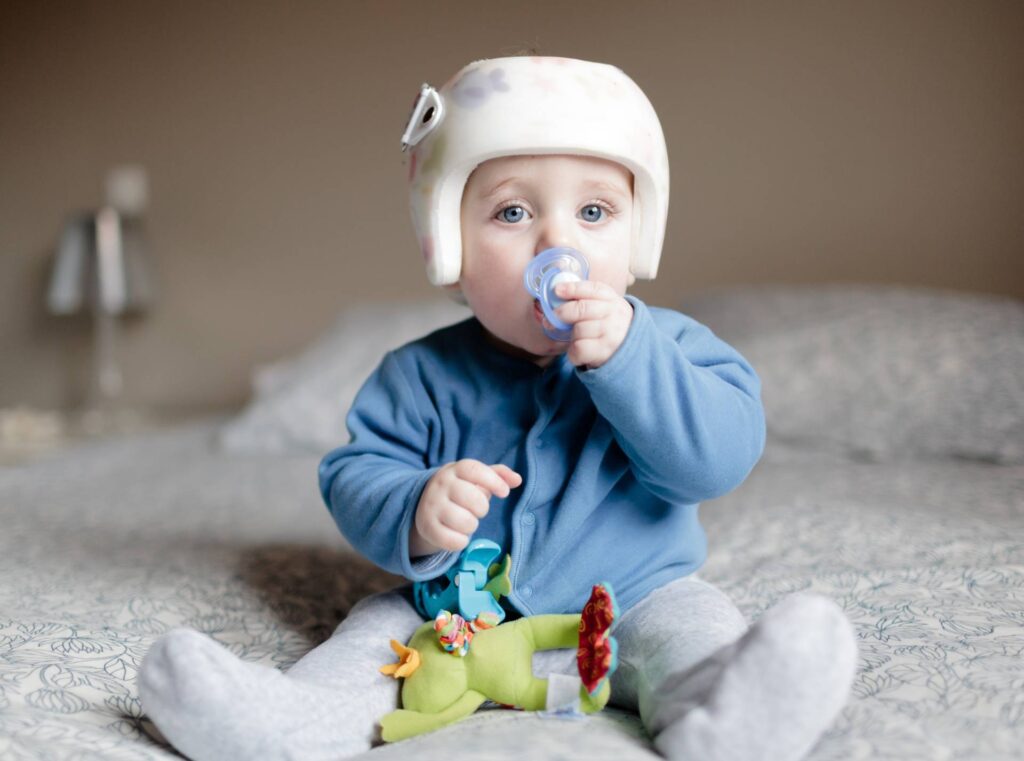 baby with helment for Plagiocephaly